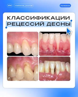 Рецессия десны. Классификация дефектов — ключ к правильной тактике.